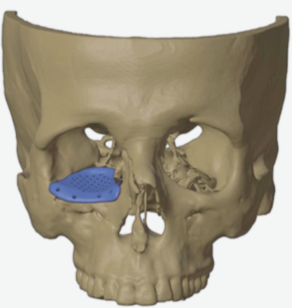 Optimizing design for Medical Implants & solving complex biomechanics of bones: Through Ansys FEA : Success Story.